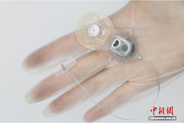 国产“听觉脑干植入体”获批上市 更多先天性耳聋患儿迎来“有声”希望-易网健康<a href=/jkys/ target=_blank class=infotextkey>养生</a>网 国产“听觉脑干植入体”获批上市 更多先天性耳聋患儿迎来“有声”希望