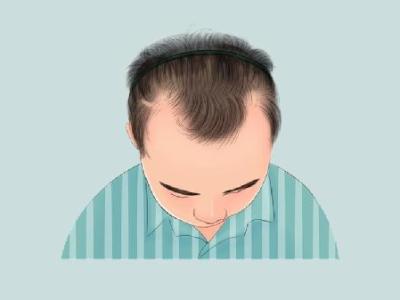 发际线过高应该怎么处理