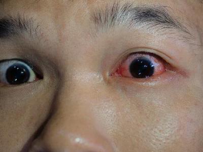 眼结膜干燥症怎么治疗