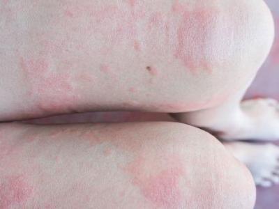 以为是湿疹？结果竟是癌，且已转移！医生：很多患者去错科室了