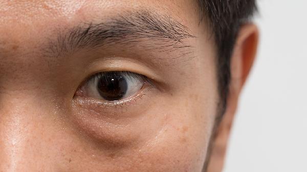 怎样去掉遗传眼袋-易网<a href=/ target=_blank class=infotextkey>健康养生</a>网 怎样去掉遗传眼袋