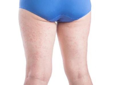 大腿局部吸脂500毫升多吗