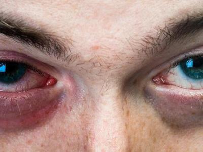 黑眼袋形成原因有哪些